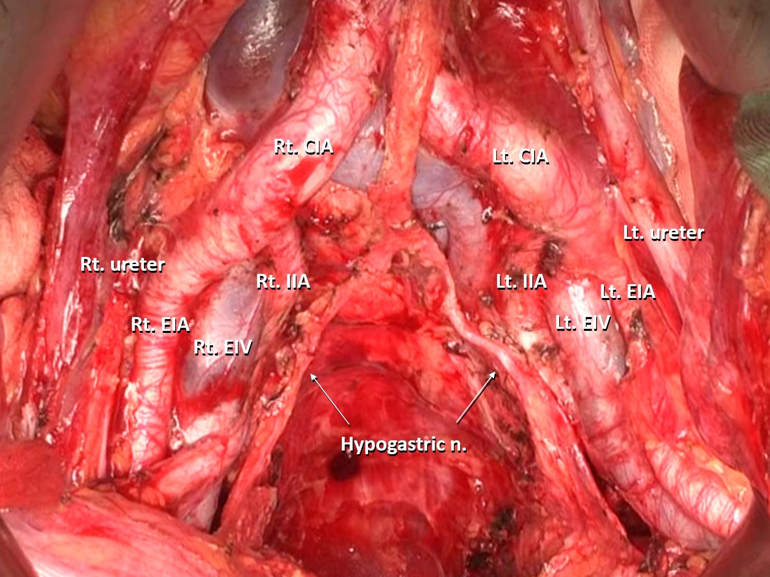Indication Of Lateral Lymph Node Dissection In Rectal Cancer Chord