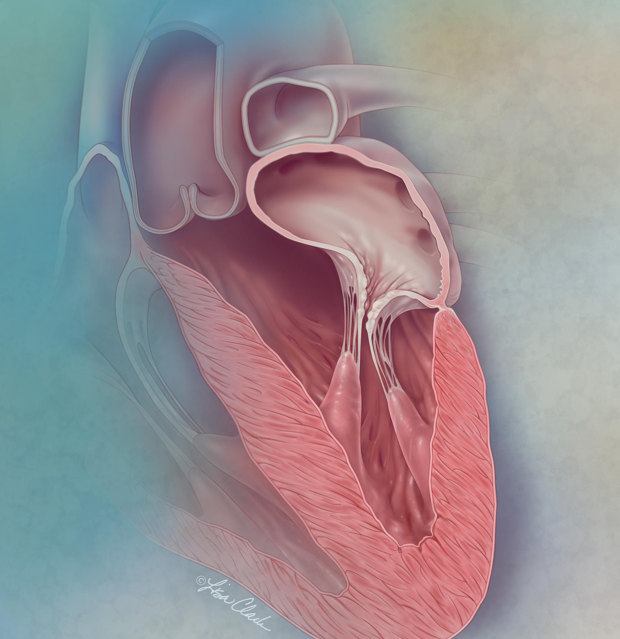 surgical-indication-of-mitral-regurgitation-chord